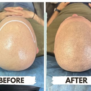 Just a natural, realistic result that gives the appearance of a fuller, sharper-looking hairline. 👌