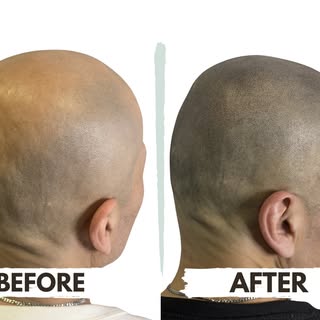 A natural-looking Crown transformation. 👌

This before-and-after shows how Scalp Micropigmentation 