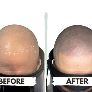 A natural-looking hairline can make all the difference. 👌

This before-and-after transformation sho