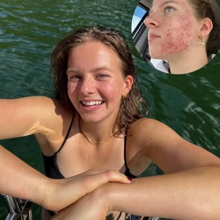 Clear skin is possible ✨