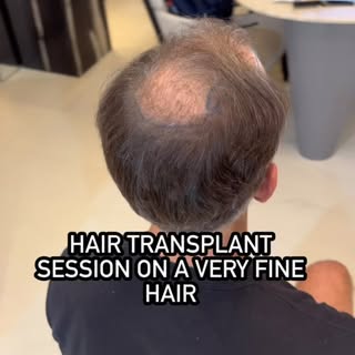 One day to cover the entire bald area. 👆🏻

Now the journey begins. We look forward to following hi