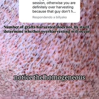 🇺🇸 Postoperative day two.

In this video, I’m showing the donor area of a patient from Ohio after 