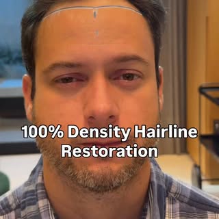 100% density to restore this hairline, with a gradual fade toward the crown. Take a closer look at t