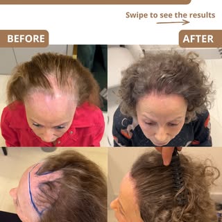 One of the Most Challenging Hair Transplants We Perform 👇🏻

This case involved frontal fibrosing a