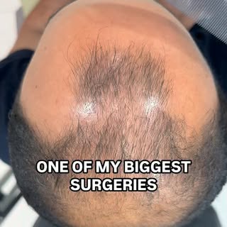 One of the biggest hair transplant cases I’ve ever performed. 🐪🇶🇦

This case involves diffuse thi