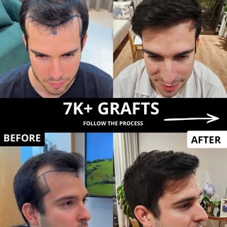 He came to us with a moderate, progressing degree of hair loss. 

We did 7K grafts — all in a single