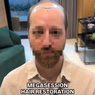 Norwood 6-7 Hair Restoration Megasession 🇦🇹

We planned a comprehensive approach to cover the uppe
