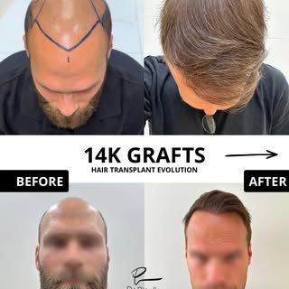 Norwood 7

The most advanced stage of the Norwood scale.

14K grafts to restore coverage across a la