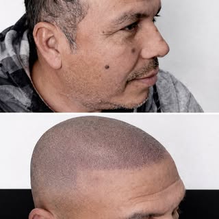🔥 ¡RECUPERA TU IMAGEN CON ESTILO! 🔥

💈 MICROPIGMENTACIÓN CAPILAR
✨ Look rapado natural y definido