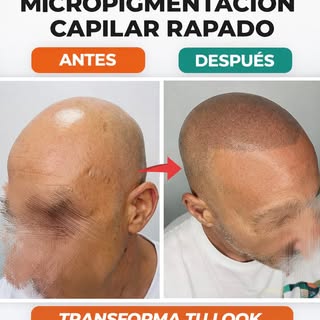 ¿Sueñas con un look rapado perfecto sin preocuparte por la caída del cabello? 💥La micropigmentación
