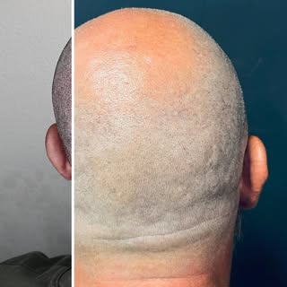 ¿Sueñas con un look rapado definido y natural? La micropigmentación capilar recrea el efecto de un c