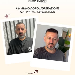 Il trapianto di capelli è un intervento che si conclude in un solo giorno, ma la vera trasformazione