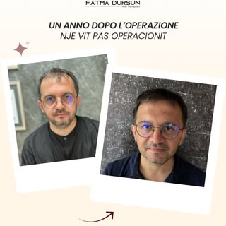 Una corretta progettazione dell’attaccatura dei capelli, una distribuzione equilibrata degli innesti