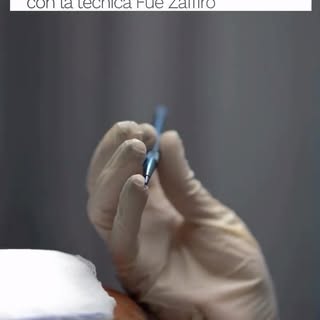 La tecnica Zaffiro è un metodo utilizzato per l’apertura dei canali durante il trapianto di capelli.