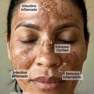 O melasma não é só uma mancha.

É evitar fotos.
É se esconder atrás da maquiagem.
É perder a confian