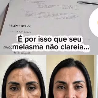 Seu melasma não está só na pele.

Quando você trata só por fora… até melhora, mas depois volta.

Iss