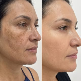 Melasma não se controla apenas com cremes.

Este resultado é fruto de um diagnóstico correto, anális