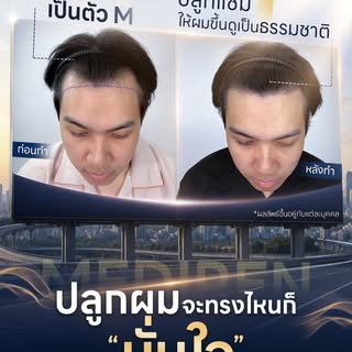 ปลูกผมแก้ทรงตัว M ...ให้เป็นทรงไหนก็มั่นใจ! 💇‍♂️✨ 
เติมเต็มแนวไรผมให้แน่น และเรียงตัวสวยดูเป็นธรรมช