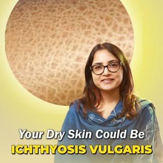 Your Dry Skin Could Be Ichthyosis Vulgaris 
.
.
.
.
[Ichthyosis Vulgaris, Dry Skin Treatment, Urea M