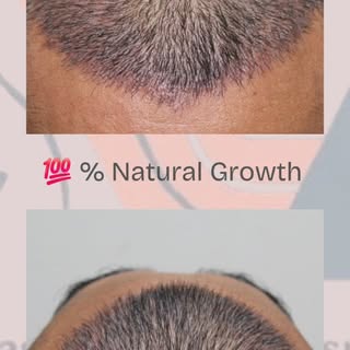 💯 % Natural Result of Hair Transplant 

📞For  more information call now: +91 63 55766 940

📍201-2