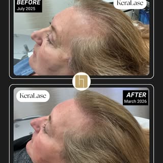 Real results, real confidence ✨

This patient was treated by Dr. Hoang for hair loss using a combina
