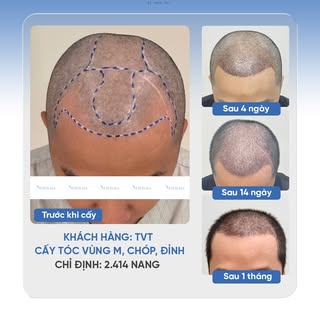 KHI HÓI CHỮ M VÀ THƯA ĐỈNH ĐẦU CÙNG XUẤT HIỆN
🔹 Khách hàng: TVT
🔹 Cấy tóc vùng M, chóp, đỉnh
🔹 Ch