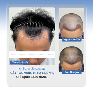 💇‍♂️ HẠ NHẸ ĐƯỜNG CHÂN TÓC, CÂN ĐỐI LẠI TỶ LỆ GƯƠNG MẶT
🔹 Khách hàng: NBN
🔹 Cấy tóc vùng M, hạ li