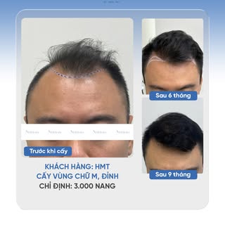 CẢI THIỆN VÙNG CHỮ M VÀ ĐỈNH ĐẦU CHO KHÁCH HÀNG HMT

🔹 Khách hàng: HMT
🔹 Cấy tóc vùng M, đỉnh
🔹 C