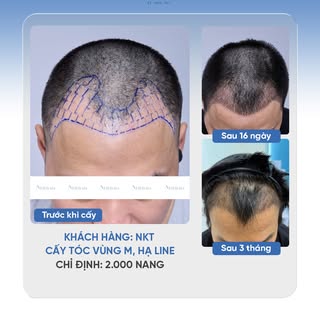 KHÁCH HÀNG NKT CẢI THIỆN VÙNG CHỮ M, HẠ LINE TÓC TỰ NHIÊN
🔹 Khách hàng: NKT
🔹 Cấy tóc vùng M, hạ l