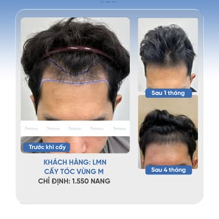 CHỈ 1.550 NANG CHO SỰ THAY ĐỔI RÕ RỆT
🔹 Khách hàng: LMN
🔹 Cấy tóc vùng M
🔹 Chỉ định: 1550 nang tó
