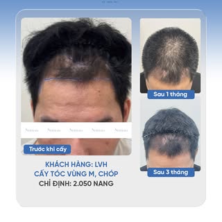 💇‍♂️ CẢI THIỆN ĐƯỜNG CHÂN TÓC CHO ANH LVH VỚI 2050 NANG TÓC 

🔹 Khách hàng: LVH
🔹 Cấy tóc vùng M,
