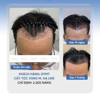 💇‍♂️ SAU 1 THÁNG, ĐƯỜNG CHÂN TÓC MỚI CỦA ANH ĐTMT ĐANG DẦN ĐỊNH HÌNH
🔹 Khách hàng: ĐTMT
🔹 Cấy tóc