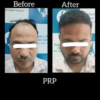 For the people of Satara, introducing city’s first US FDA approved Triple wavelength laser for hair 