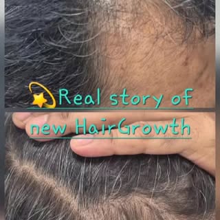 🥳Real STORIES; Real RESULT & the  Hair growth🥳 Watch our happy patient of Androgenic Alopecia with