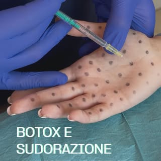 Con l’arrivo del caldo, c’è chi pensa alle vacanze… e chi al problema della sudorazione eccessiva. ☀