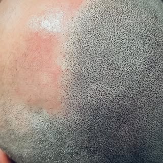 • SCALP MICROPIGMENTATION • •••••••••••••••••••••••••••••••••••••••••••••••••••••••••••••Ever notice