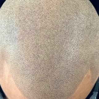 Stop hiding hairloss. It’s time for action. Scalp Micropigmentation (SMP) is the most permanent, und