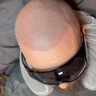 No Cap: Das ist kein Filter. 🔥

Das ist Scalp Micropigmentation.😎

Realistische Haaroptik.
Cleaner