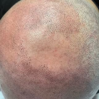 Scalp Micro = natürliche Haaroptik ohne OP💯 •••••••••••••••••••••••••••••••••••••••••••••••••••••••