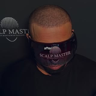 🔥 Vorher ➡️ Nachher nach der 1. SMP-Session

Schon nach der ersten Behandlung ist eine deutliche Ve