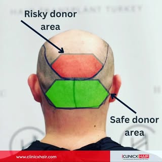 Hair transplant secrets: It’s all about the donor zone! 🤫💯

A great hairline means nothing if the 