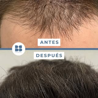 🤔 Uno de los errores más habituales es comparar un injerto capilar con otro.

Cada paciente tiene u