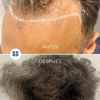 💬 ¿Puede rechazarse el pelo implantado? Es una de las preguntas más habituales en consulta.

La res
