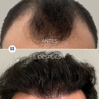 ✂️ ¿Sabías que la zona donante es uno de los factores que determina el éxito de un trasplante capila