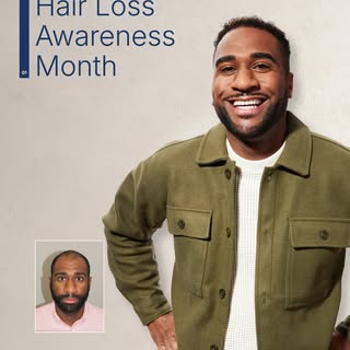 Hair loss is common. Talking about it openly? Not so much.

It affects people across all ages, backg