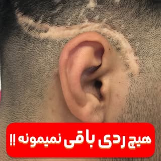 ⁨	هیچ جای زخمی روی سرت دائمی نیست!!!
نقاطی که با موهات ، مو نمیزنه!!!!
با میکرو اسکالپ رد هیچ زخمی ر