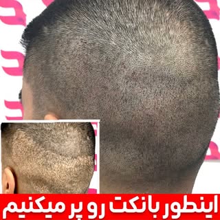⁨	کلمه «اسکالپ» رو تایپ کن تا اطلاعات این روش رو کامل ارسال کنیم.

آسیب به بافت بانک‌مو بعد از انجام