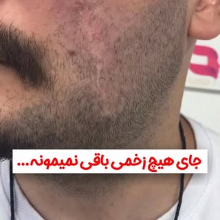 ⁨	دیگه جای هیچ زخمی روی سر یا صورتت نمیتونه آزارت بده….
با انجام #میکرواسکالپ روی صورت و ناحیه ریش ک