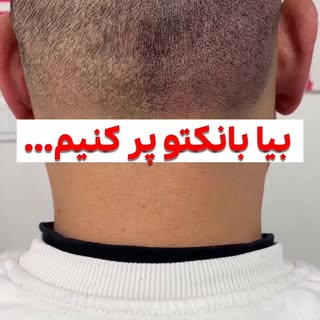 نمیخوان بدونی بعد از کاشت مو جای مویی که برداشت میشه قرار نیست مویی مجدد رشد کنه و همیشه جاش خالیه!!