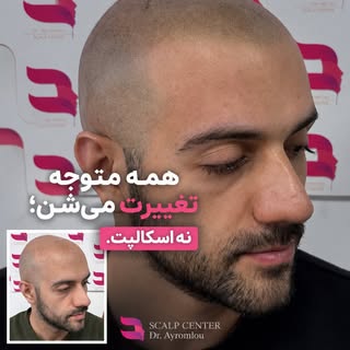 همه قرار نیست کاشت مو انجام بدن…
و حتی همه‌ی کسانی هم که کاشت مو انجام دادن، لزوماً به نتیجه‌ای که آ